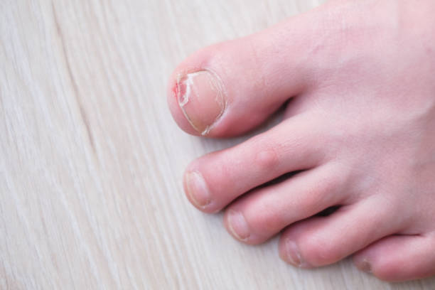 Broken Toe Nail Stock Photos, Pictures & Royalty-Free Images - iStock Broken Toe Nail Stock Photos, Pictures & Royalty-Free Images - iStock