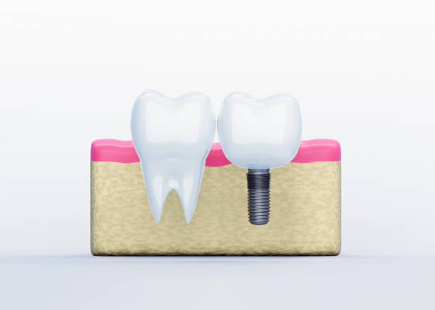 istock White Tooth and Tooth Implant in gums on white background, artificial tooth, 3d render 1263934438