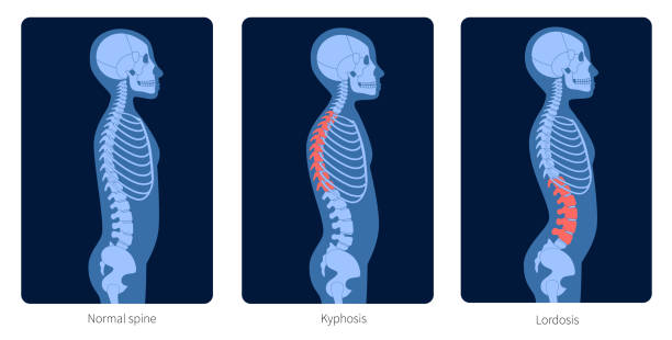 Spine X ray Normal spine, lordosis and kyphosis. Scoliosis in child body. XRay flat vector illustration. Backbone and skeleton anatomy in boy silhouette. Orthopedic poster. Medical exam in spinal pain center kyphosis stock illustrations