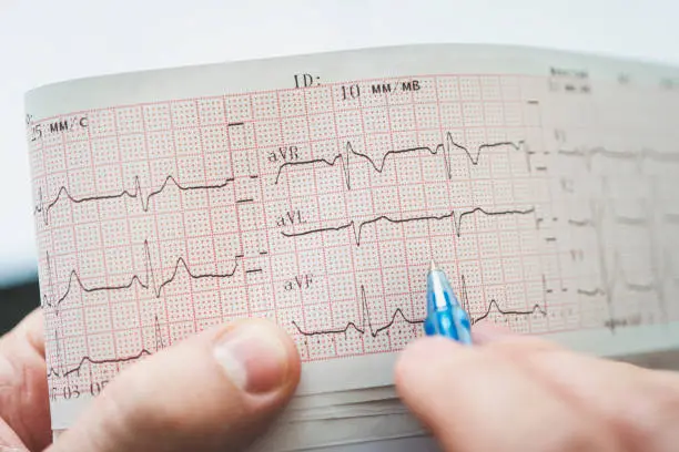 Electrocardiogram in the hands of doctor. heart health check.