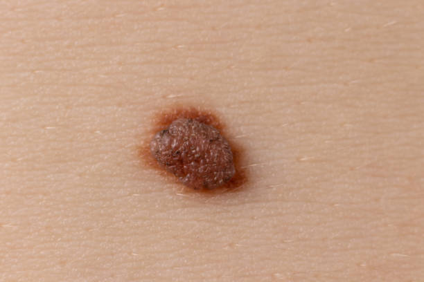 istock Mole birthmark nevus macro photo on human skin. Close up. 1264091093