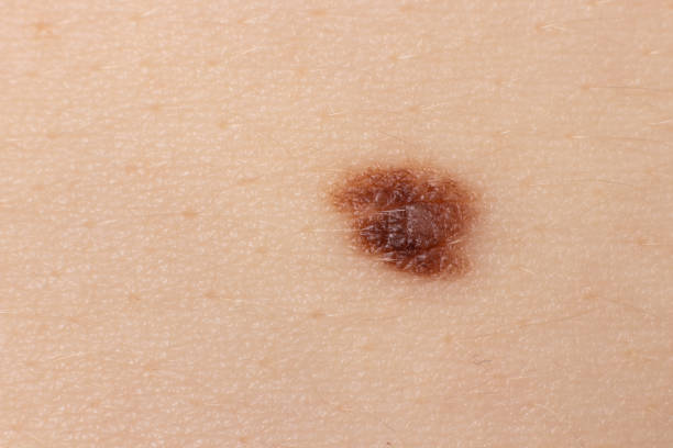 istock Mole birthmark nevus macro photo on human skin. Close up. 1264091096