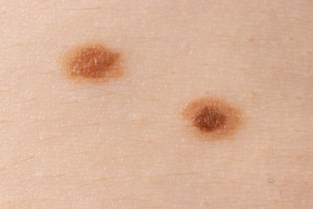 istock Mole birthmark nevus macro photo on human skin. Close up. 1264091129