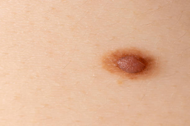istock Mole birthmark nevus macro photo on human skin. Close up. 1264091147