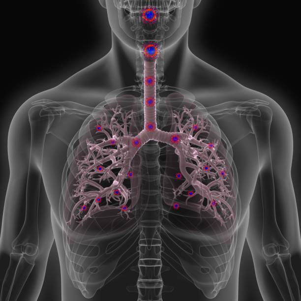 istock 3d illustration human lungs infected with corona virus 1264197604