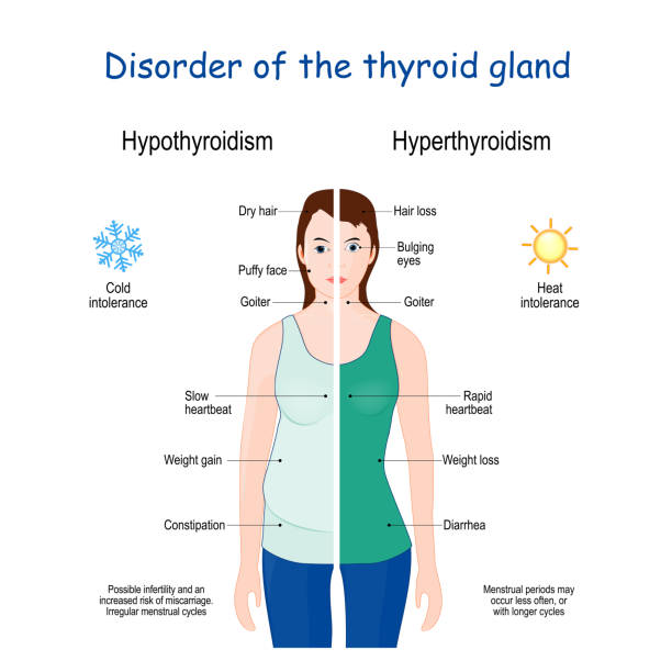 Female with Signs and symptoms of different thyroid gland diseases Hyperthyroidism and Hypothyroidism comparisons. disorders of the endocrine system. Female with Signs and symptoms of different thyroid gland diseases thyroid gland stock illustrations