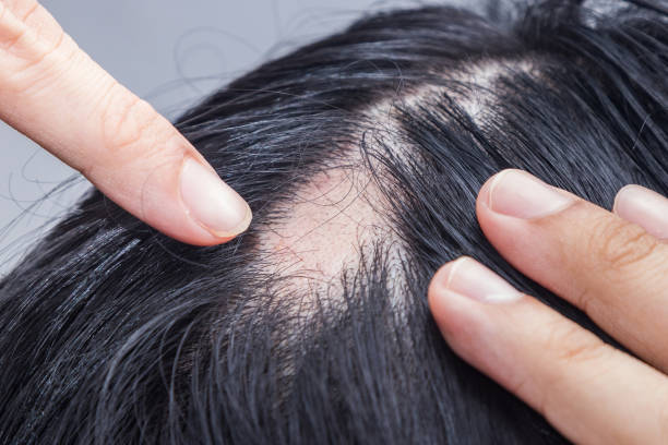 탈모증 아레아타 - 스팟 대머리는 머리카락이 신체의 일부 또는 모든 영역에서 손실되는 상태입니다. - 탈모 뉴스 사진 이미지