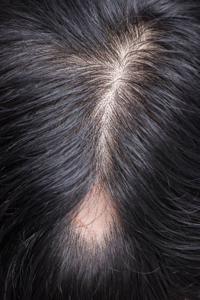 Alopecia Areata - Spot Baldness is a condition in which hair is lost from some or all areas of the body. stock photo
