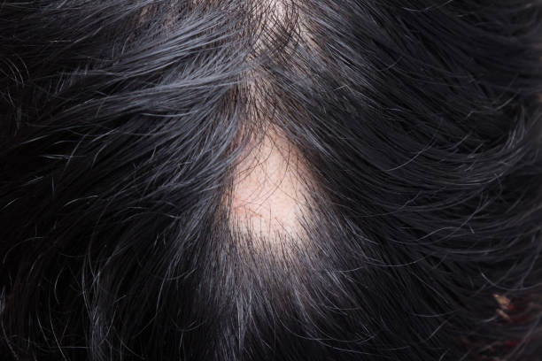 Alopecia Areata - Spot Baldness is a condition in which hair is lost from some or all areas of the body. stock photo