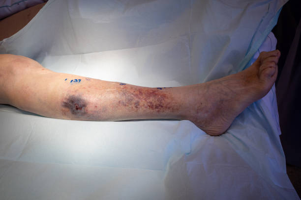 istock large haematoma is located on a lower leg, its spread is marked with a pen 1264346660