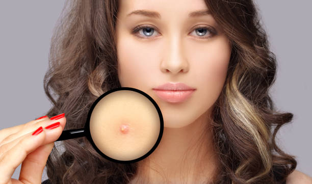 istock Post-Acne Marks /Treating Acne Scars.Acne Scar Removal 1264460021
