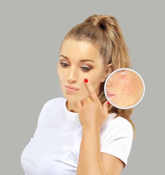 istock Post-Acne Marks /Treating Acne Scars.Acne Scar Removal 1264461109