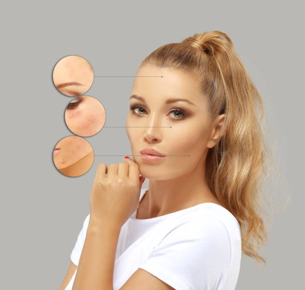 istock Post-Acne Marks /Treating Acne Scars.Acne Scar Removal 1264461150