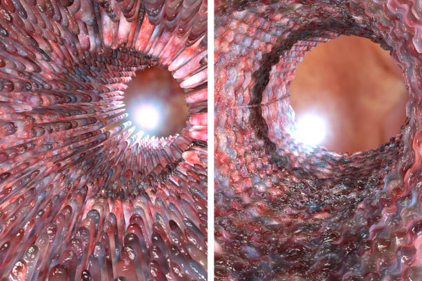 Celiac Disease Small Intestine