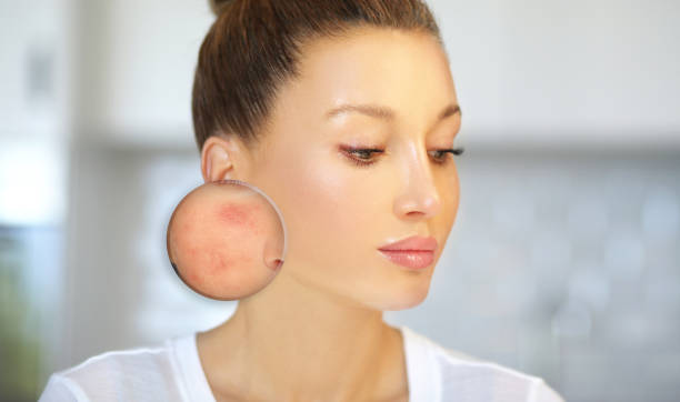 istock Post-Acne Marks /Treating Acne Scars.Acne Scar Removal 1264636446