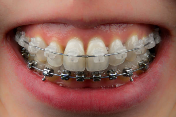 istock Teeth with ceramic and metal braces closeup 1264694041