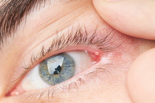 istock eyelid pimple macro close up. pimple near eye. hygiene problem 1264869767
