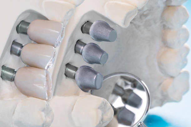 istock Close up implant and prosthodontic model. 1264920644