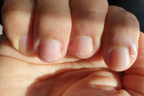 istock Close-up of brittle nails. 1264971694