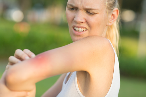 Irritated caucasian female person with redness on her arm from an insect bite at the park on a summer day. She looks in pain and scratching.