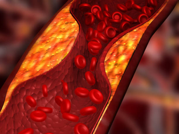 Clogged arteries, Cholesterol plaque in artery Clogged arteries, Cholesterol plaque in artery. 3d illustration atherosclerosis stock pictures, royalty-free photos & images