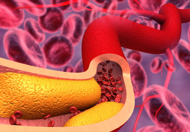Clogged arteries, Cholesterol plaque in artery stock photo
