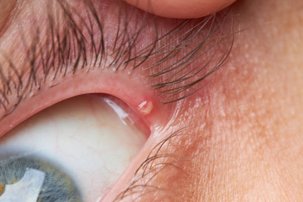 istock eyelid pimple macro close up. pimple near eye. hygiene problem 1265290443
