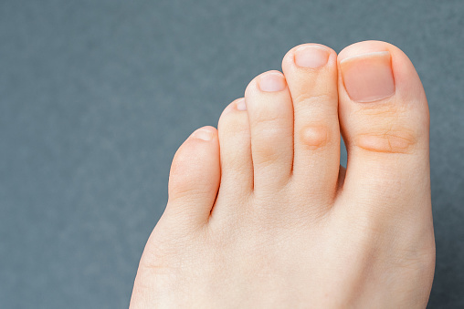 A young woman has hard corns and calluses on her toes from wearing shoes that uncomfortable and don\