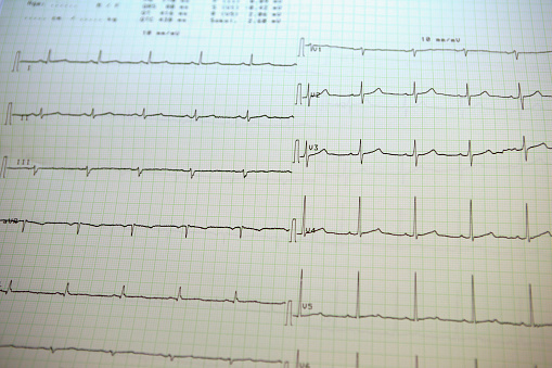 ECG in supraventricular tachycardia, a rapid heart rate originating above the ventricles, causing palpitations and dizziness. 3D illustration shows narrow QRS complexes and P waves hidden in T waves.