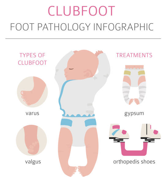 足の変形、医学のデイーズインフォグラフィック。クラブフットの欠陥 - deformed点のイラスト素材／クリップアート素材／マンガ素材／アイコン素材