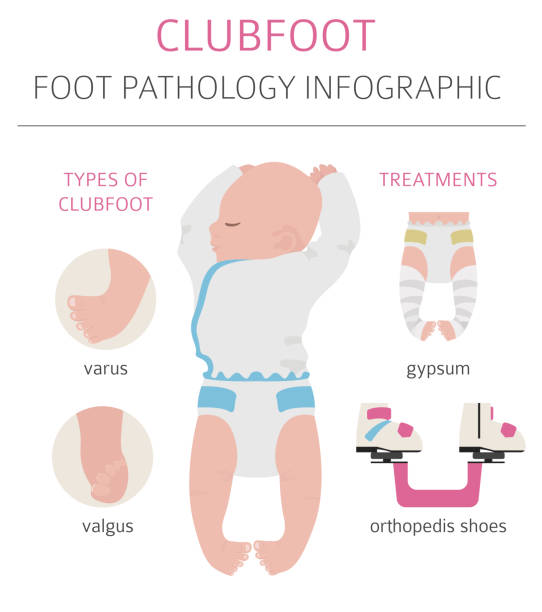 Foot deformation, medical desease infographic. Clubfoot defect Foot deformation, medical desease infographic. Clubfoot defect. Vector illustration deformed stock illustrations