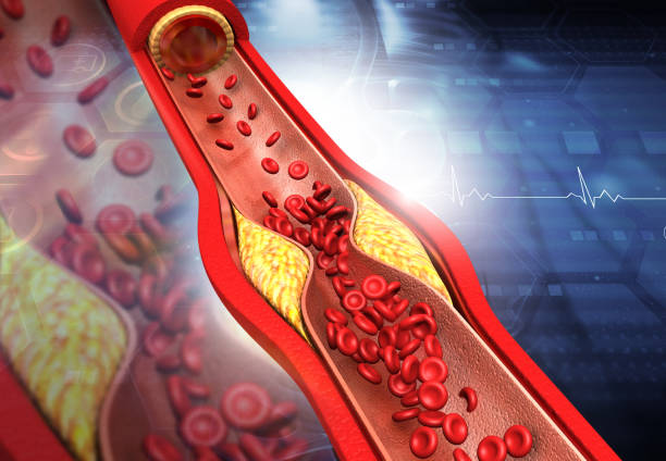 Clogged arteries, Cholesterol plaque in artery Clogged arteries, Cholesterol plaque in artery. 3d illustration blood clot stock pictures, royalty-free photos & images