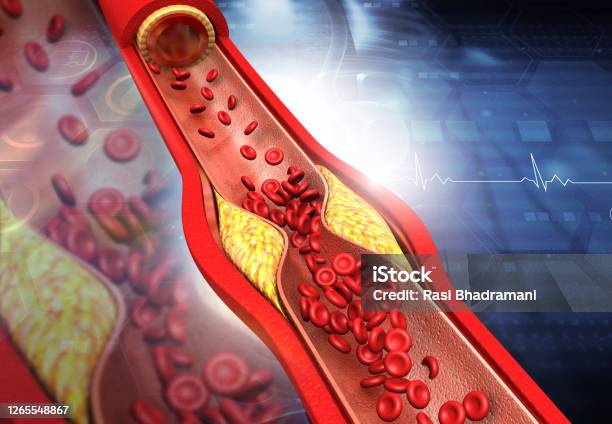 Clogged Arteries Cholesterol Plaque In Artery Stock Photo - Download Image Now - Cholesterol, Artery, Occlusion