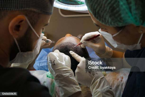 Hair Transplant Stock Photo - Download Image Now - Hair Transplant, Human  Hair, Dentist - iStock