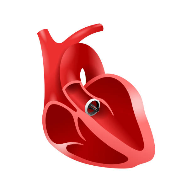 illustrations, cliparts, dessins animés et icônes de implant aortique de bileaflet artificiel de coeur - valvule humaine