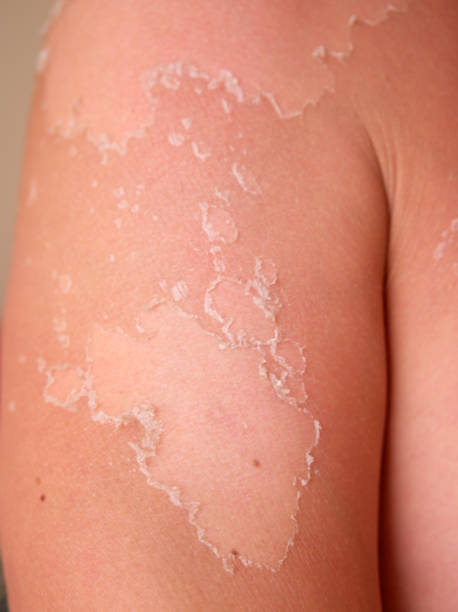 istock sunburn peeling skin of man's shoulders 1265928758