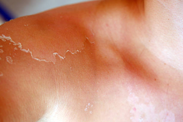 istock sunburn peeling skin of man's shoulders 1265935285