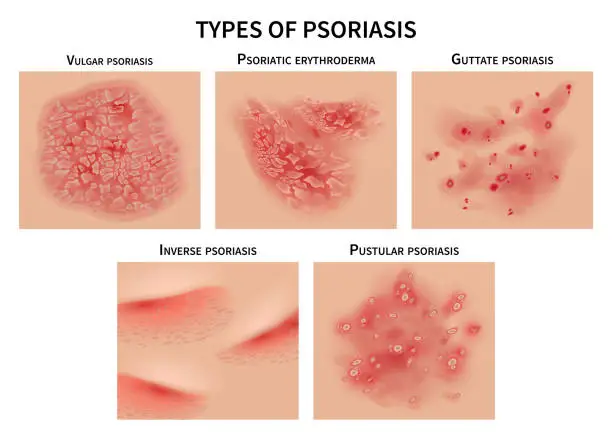 Vector illustration of Psoriasis types. Skin hives, derma diseases. Closeup medical vector illustration