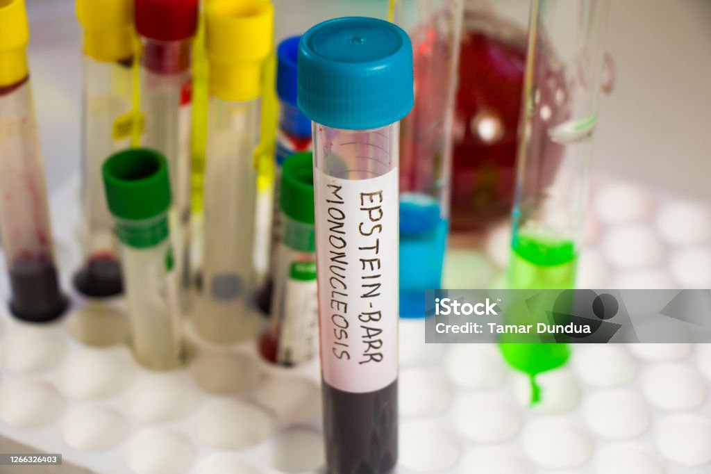 Mononucleosis And Epsteinbarr Virus Blood Test Sample In Lab On The Mononucleosis And Epsteinbarr Virus Blood Test Sample In Lab On The