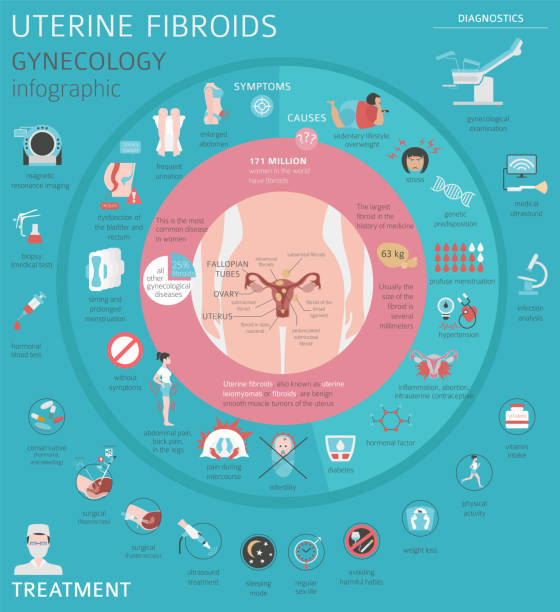 Uterine fibroids. Ginecological medical desease in women infographic Uterine fibroids. Ginecological medical desease in women infographic. Vector illustration woman ovarian cancer stock illustrations