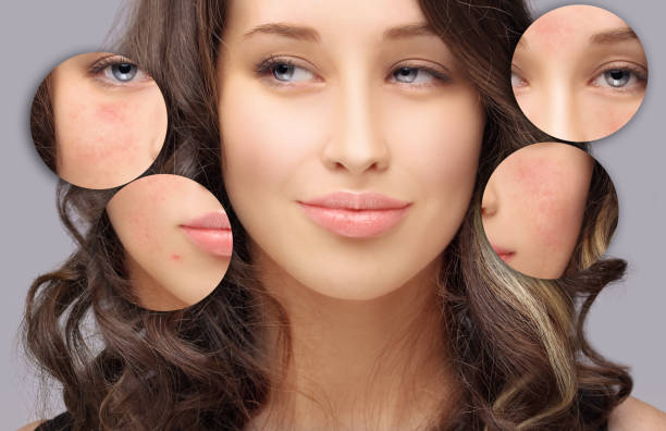 istock Post-Acne Marks /Treating Acne Scars.Acne Scar Removal 1266431467