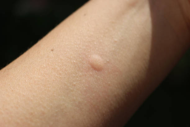 istock Mosquito bite on a female hand 1266547124