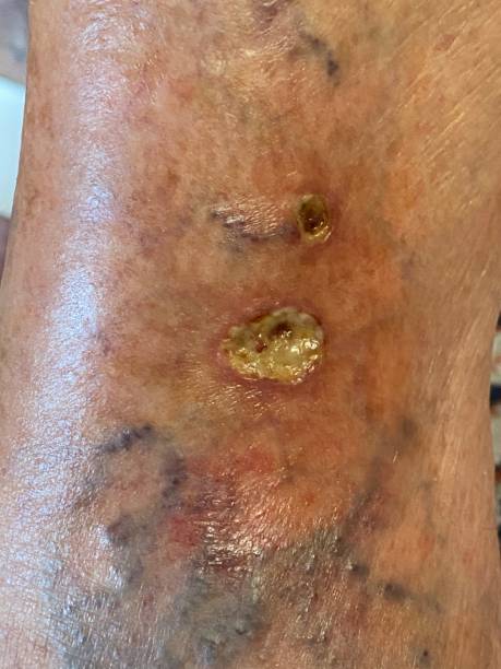 infikovaný vřed na diabetické noze - gangréna - stock snímky, obrázky a fotky