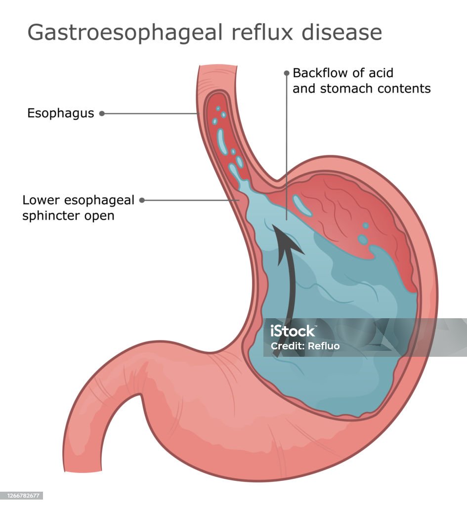 Reflü Gastroesophageal Reflux Disease Illustration Stock Illustration ...