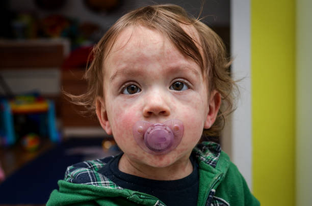 maladie virale ou allergies chez les enfants. éruption rouge de rougeole sur le bébé. - chickenpox skin condition baby illness photos et images de collection