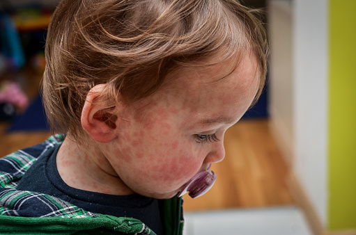 Enfermedades virales o alergias a los niños. Erupción roja por sarampión en el bebé. photo