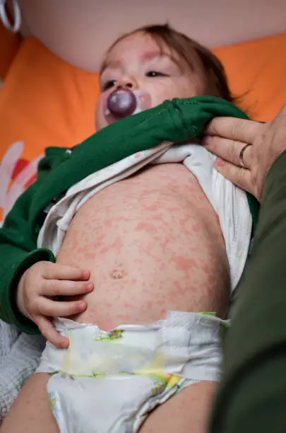Children viral disease or allergies. Red measles rash on baby. Child with viral children disease infection. Concept of viral baby disease and vaccination.