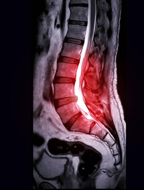 mri l-s kręgosłupa lub kręgosłupa baraniego sagittal t2 technika diagnostyki kompresji rdzenia kręgowego. - human spine human vertebra disk spinal zdjęcia i obrazy z banku zdjęć