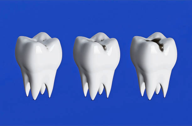 istock Three teeth in a row, Three stages of tooth decay, caries, sore teeth, 3d render 1267157809