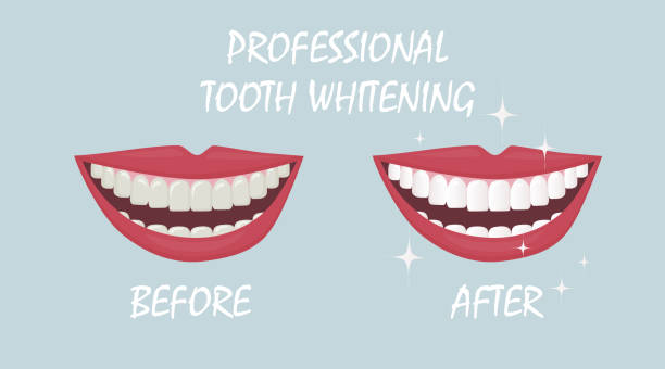 istock the smile of a man with his mouth wide open. Tooth whitening, tooth colour comparison before and after the procedure.  Daily oral hygiene. poster for dental design. Flat illustration 1267162439